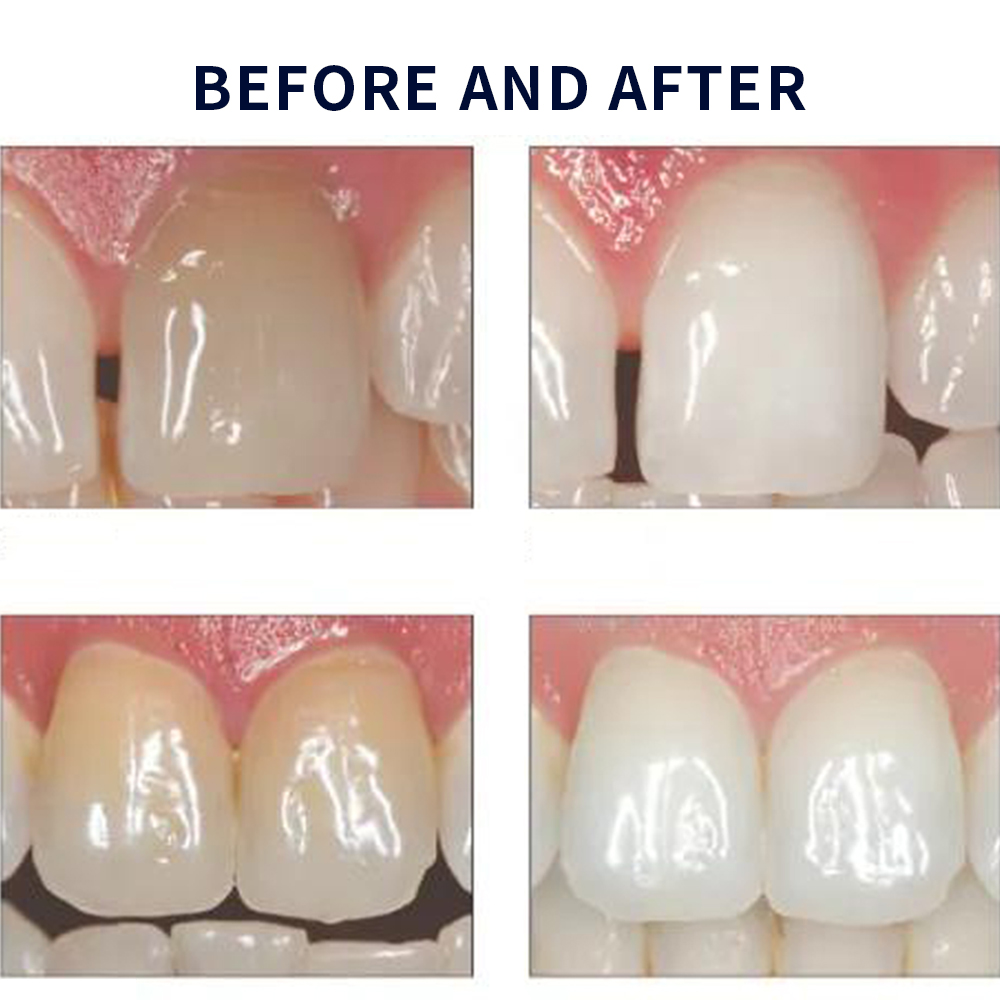 Opalescence Whitening 20% PF 2 - Teeth Whitening With Peroxide ulasan dan harga