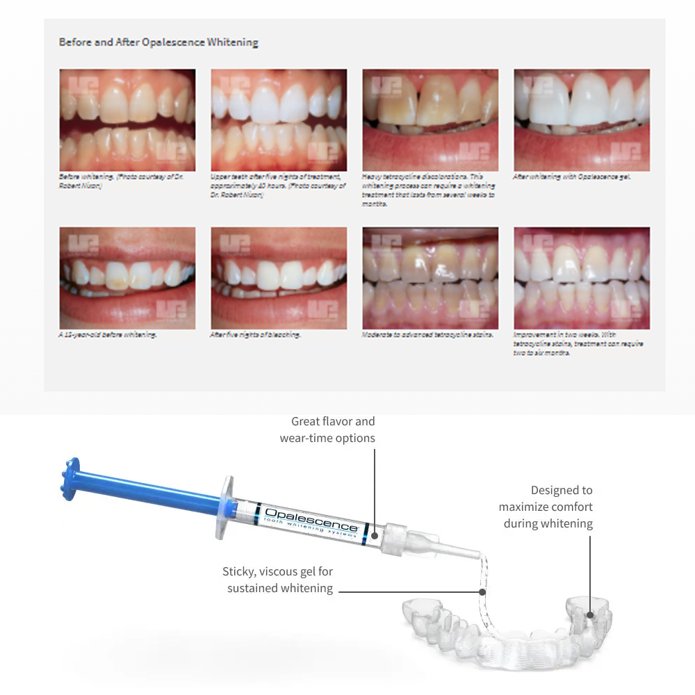 Opalescence Whitening 20% PF 2 - Teeth Whitening With Peroxide ulasan dan harga